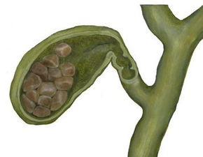 天津市三中心医院胆结石