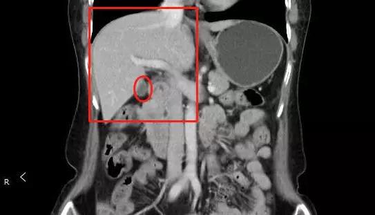 男子长期左腹痛以为是胃痛结果竟然是胆结石,原因是...