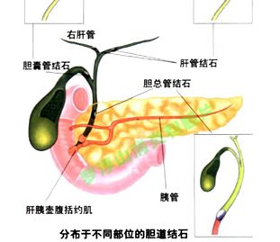 为什么会得胆结石