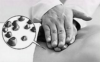 胆结石是怎样形成的 平时多吃它们,结石无痛自消