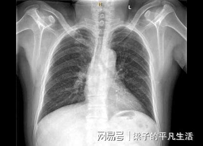 胆结石的 元凶 是什么 这6个因素都可能产生结石,早点避开