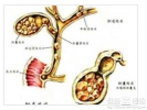 胆结石中药方剂的中医处方三