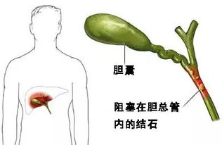 胆结石有什么危害