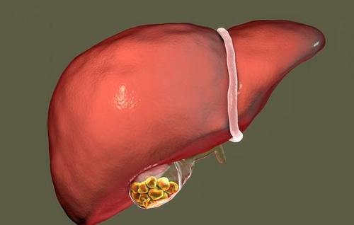 有胆结石的人,生活中应注意哪些细节呢