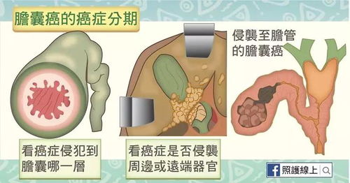 胆结石不治疗会拖成胆囊癌 有几点要特别注意