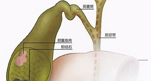 很多人害怕胆结石,那什么样的人容易得胆结石呢
