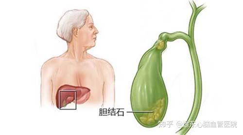 哈尔滨胆结石专科医院,胆结石应该怎么治疗呢