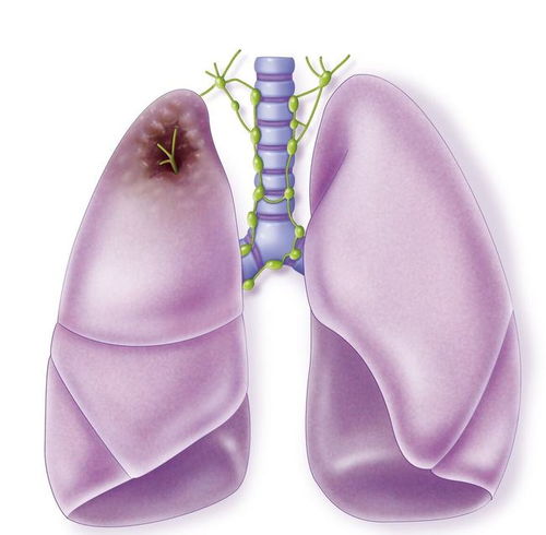 女子胸痛2周,以为胆结石,直到确诊肺癌晚期患者 我才30岁啊