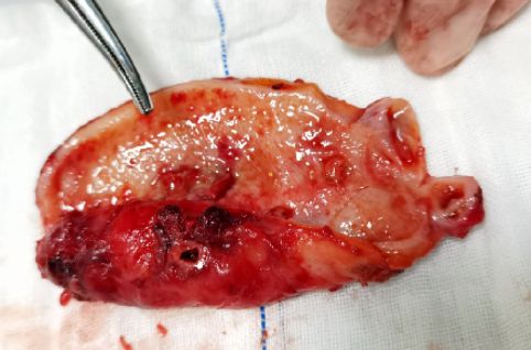 胆结石真正可怕的不是腹痛,看完惊出一身冷汗