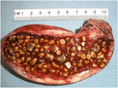 长期久坐不动,当心胆结石,这5类人最易得