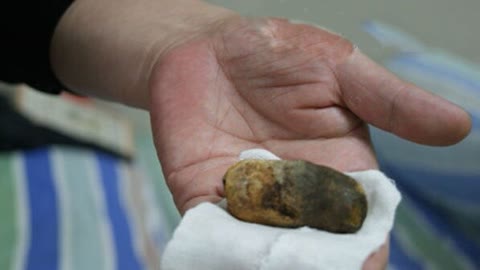 胆结石会对心脏有影响吗