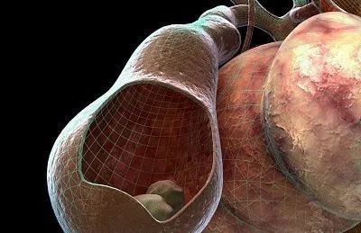 得了胆结石,自己却没感觉,要手术 切胆 吗