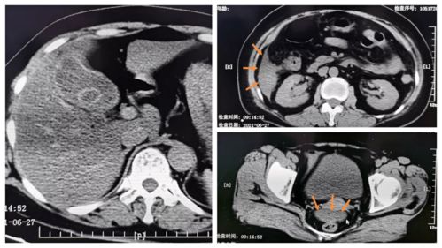 转移性右下腹痛竟然不是阑尾炎,这个疾病大多医生都没想到