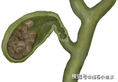 治疗胆结石的科学饮食方法都有哪些 看了这个就知道了