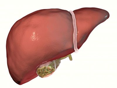 胆结石手术是大型手术吗