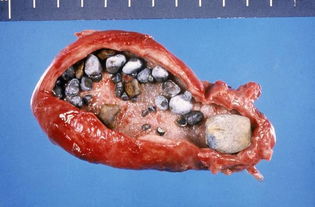 胆结石不治疗变成癌,胆囊癌到底有多可怕