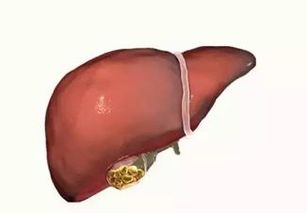 胆结石怎么去除