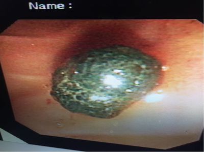 高龄合并心衰及肝硬化行ERCP胆总结石取石术