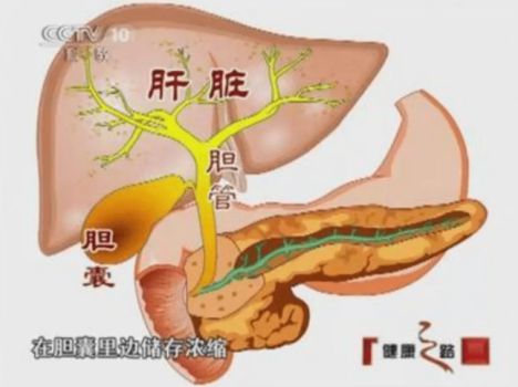 秋冬到, 10个胆结石9个发作 ,该怎么办