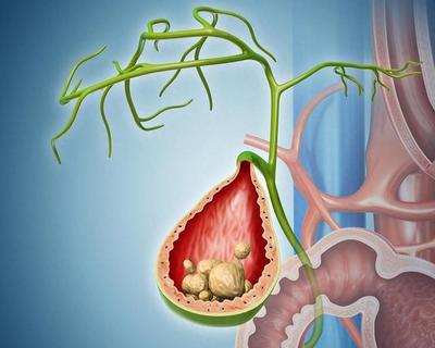 体检查出胆结石,什么情况需要手术?