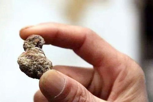 胆结石多是 吃 出来的 吃饭时的几个坏习惯,你可千万别中招