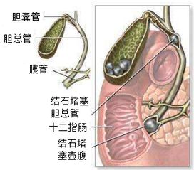 如何预防胆结石 得了胆结石怎么办 黄安华胆病科普系列