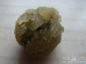 小儿患上胆结石怎么办