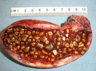 生活方式与习惯是胆结石发生的重要诱因