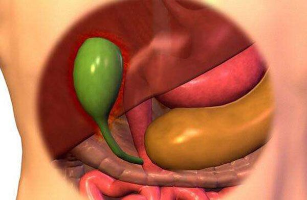 不能等的结石病——胆结石
