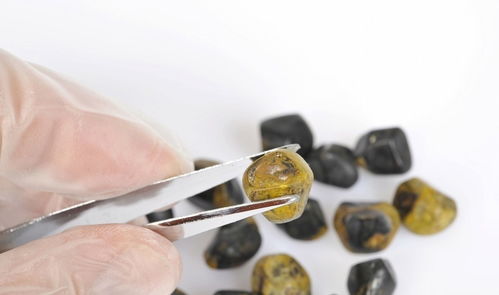 胆结石与胆囊癌 警惕癌变风险，掌握关键检查与预防要点