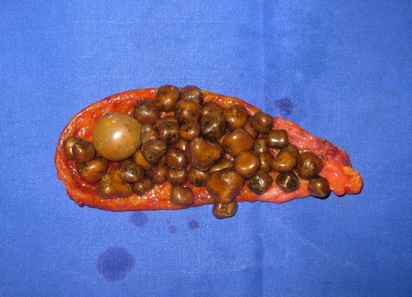 胆囊结石是否都需要手术切除？什么情况适合保胆取石？