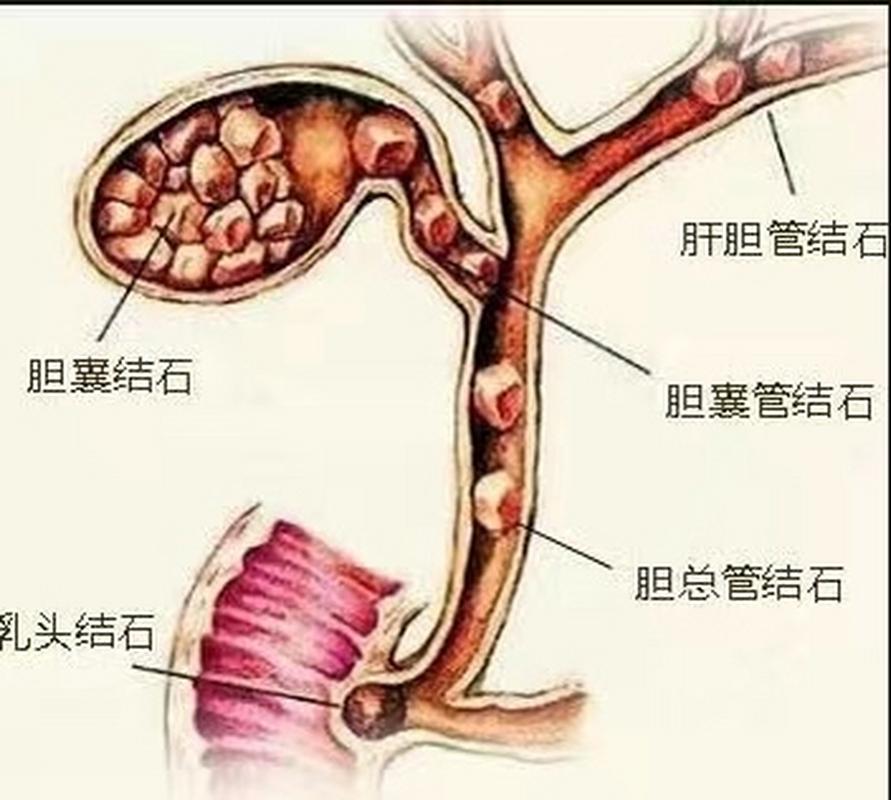 得了胆结石，一定要手术吗？