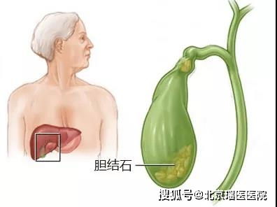 身体里哪来这么多“石头”？一文读懂胆结石、肾结石、胃结石