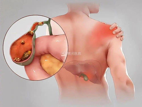 查出胆结石怎么办 切还是不切