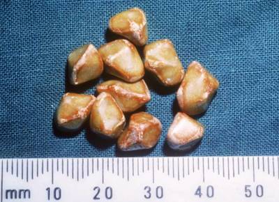 缓解胆结石疼痛的小秘密,很多人都没听说过!