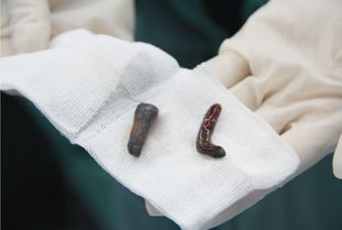 延误治疗的代价 壮小伙患胆结石6年未治，终成