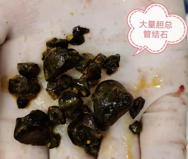 胆结石的偏方 探索民间疗法及其注意事项