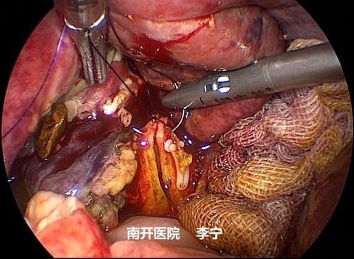 胆石症微创技术 策略与理念的新挑战
