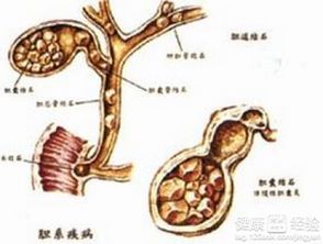 胆结石治疗新选择 保胆取石术的探索与实践