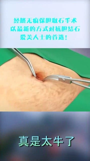 经脐无痕保胆取石术 以最新技术对抗胆结石，爱美人士的首选